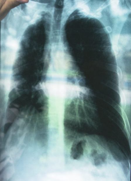 Radiografía de una persona afectada de silicosis. Imagen de archivo propio.