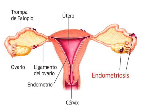 endiometriosis