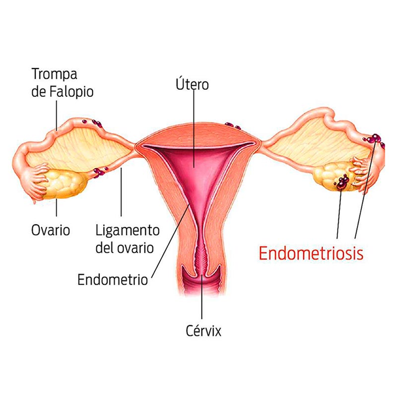 endiometriosis